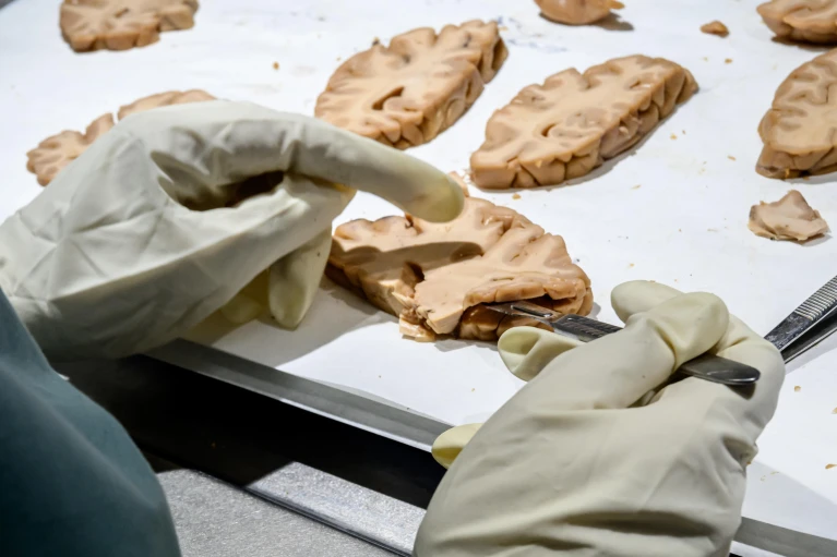 Nature dedica un artículo al papel clave de CIEN en la investigación del Alzheimer en España