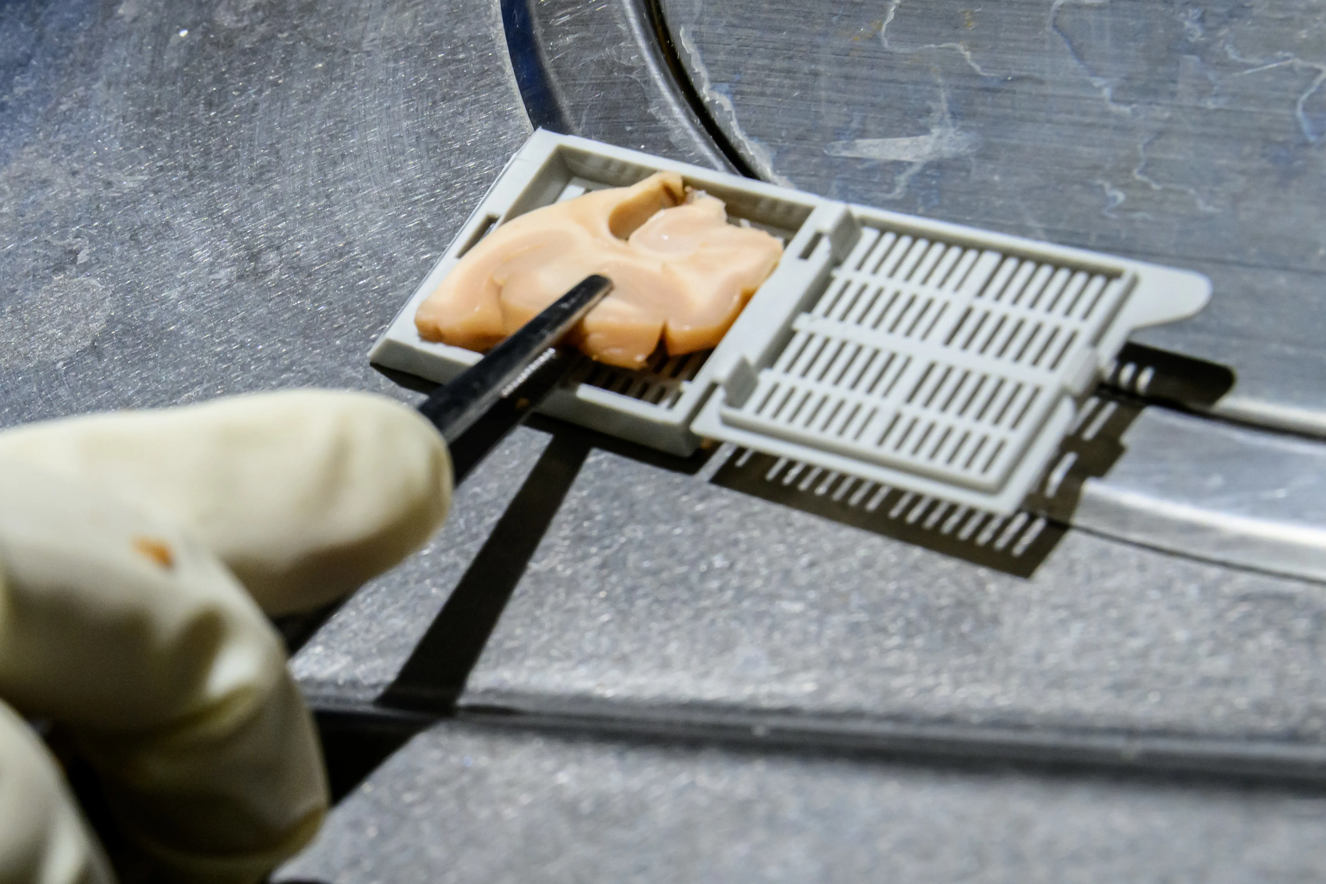 Avances en biomarcadores de tau: CIEN y la Universidad de Gotemburgo presentan un estudio de biomarcadores plasmáticos con confirmación neuropatológica post mortem.