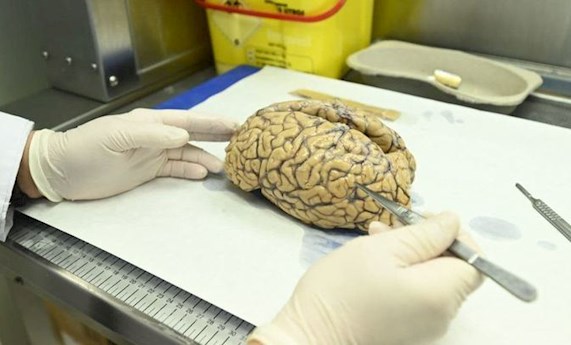 Un almacén de cerebros en Madrid: su donación, clave para la investigación médica